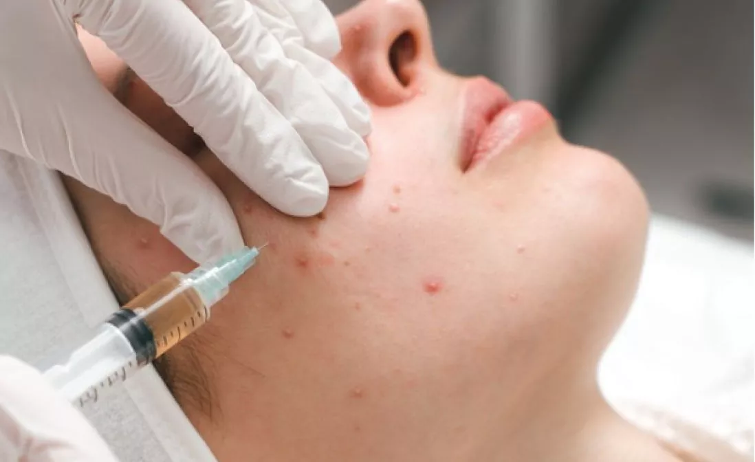 Acne Treatment Dubai